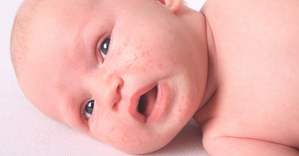 Некоторые медицинские проблемы также могут приводить к сыпи на лице у ребенка. Например, дети могут развивать экзему – хроническое воспаление кожи, которое проявляется сыпью, зудом и покраснениями. Экзема может быть вызвана различными факторами, включая генетическую предрасположенность, аллергии или сниженную иммунную систему.