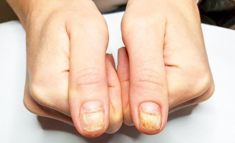 Лечение ногтей на руках
