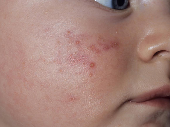 Сыпь на лице у ребенка в 1 месяц Причины появления