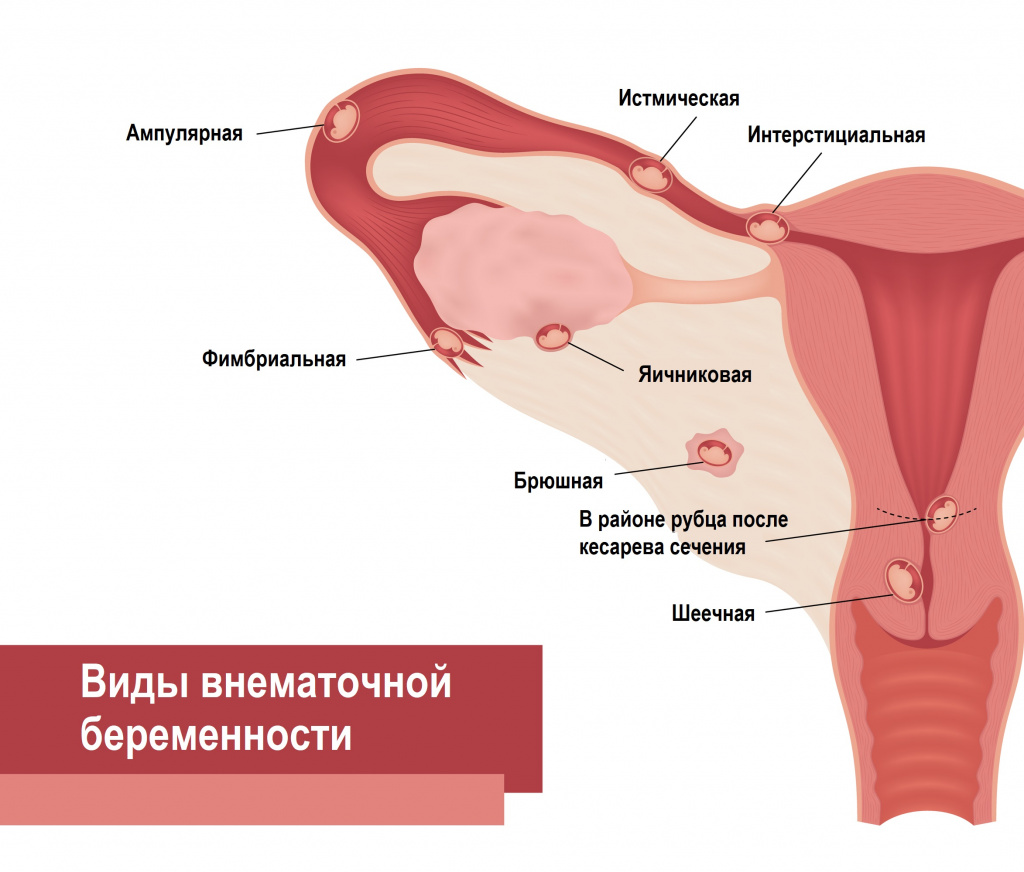 Классификация внематочной беременности