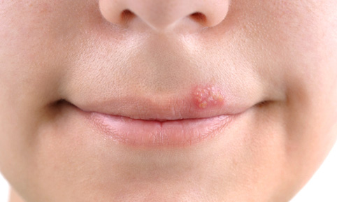 Частые причины возникновения простуды на губе