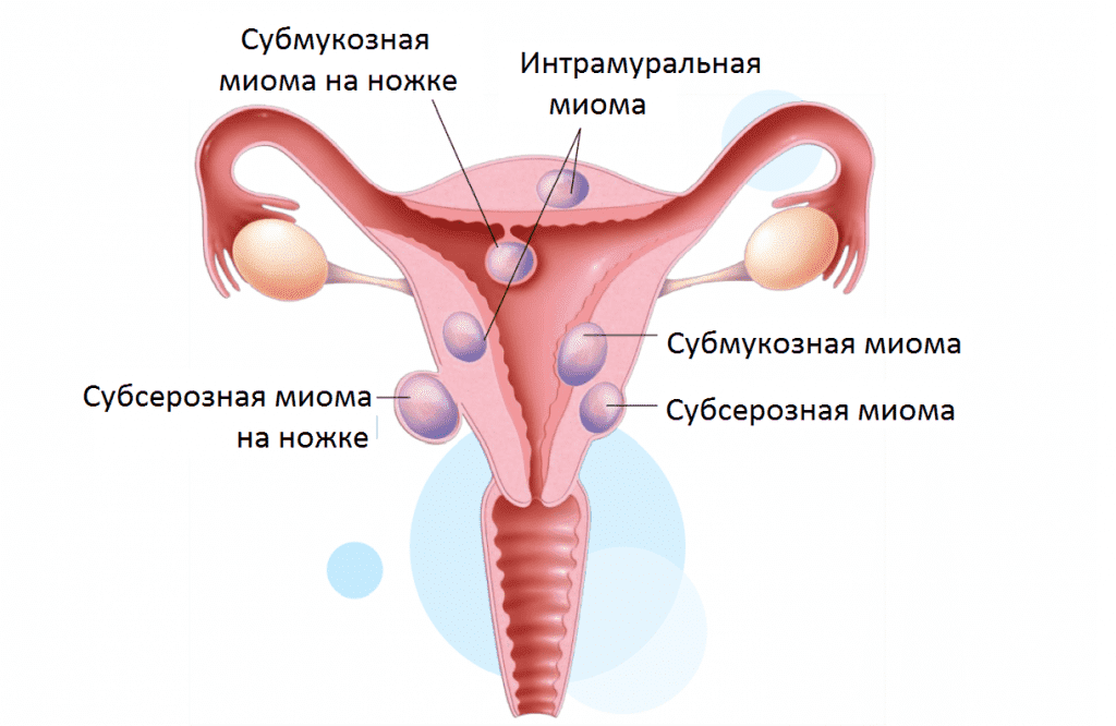 Фибромиома матки - это доброкачественное заболевание, которое часто встречается у женщин в репродуктивном возрасте. Оно характеризуется образованием узлов в мышечной ткани матки. Узлы могут быть разного размера и располагаться как внутри матки, так и на ее поверхности.