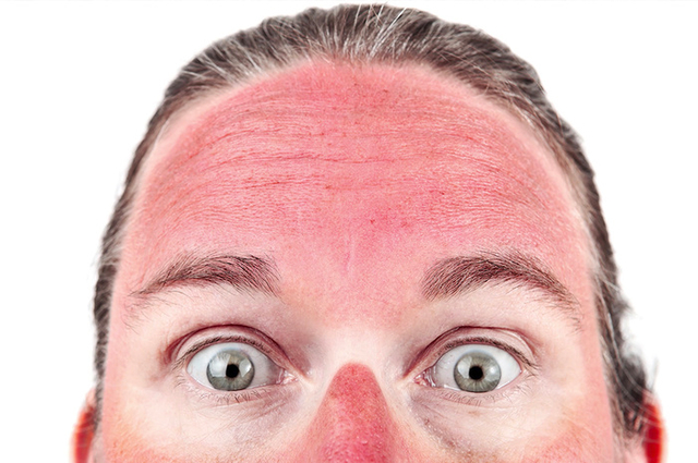 Что делать при аллергии на солнечные ожоги
