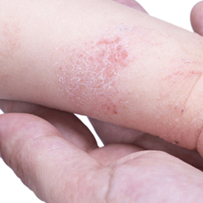 Дерматит – это воспалительное заболевание кожи, которое может проявляться различными симптомами, такими как зуд, покраснение, шелушение и опухание. Дерматит может возникать из-за разных причин, включая контакт с аллергенами, раздражителями или грибками.
