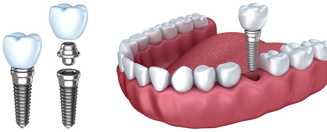 Имплантация зубов основные этапы их особенности и значение