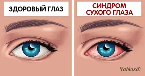Синдром сухого глаза лечение и профилактика