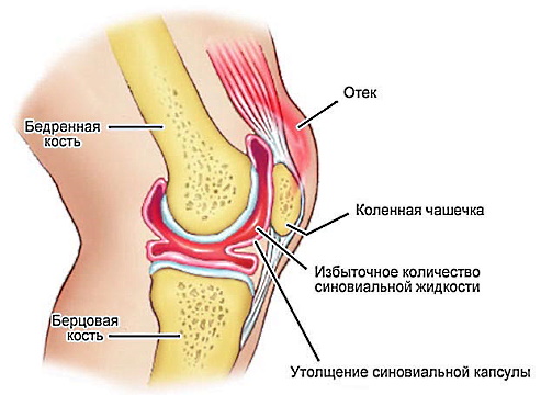 Существует несколько причин, почему возникает щелканье суставов. Одной из них является обычная физиологическая особенность организма. При движении суставы меняют свое положение, и это сопровождается мелькими звуками. Также, это может быть связано с изменениями в работе мускулатуры или сухостью суставной жидкости. В некоторых случаях, щелканье суставов может быть признаком более серьезного заболевания, такого как артроз или воспаление суставов.