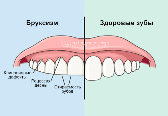 Профилактика скрежета зубами