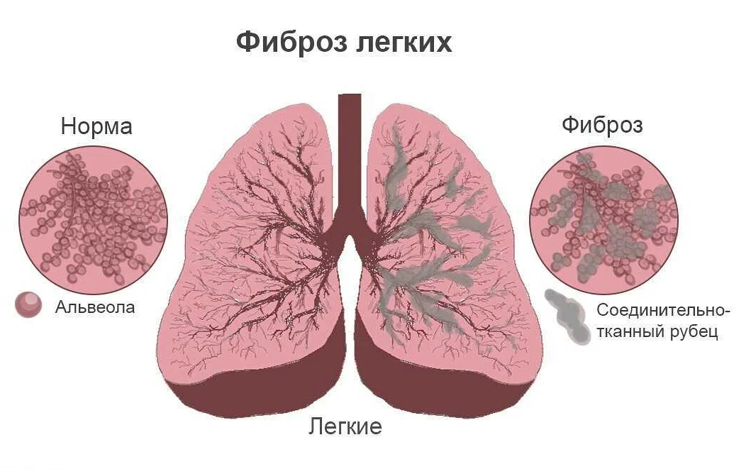 Разновидности заболевания