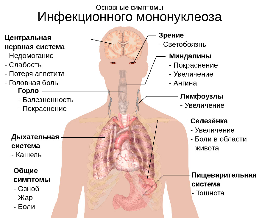 Инфекционный мононуклеоз у ребенка симптомы и лечение