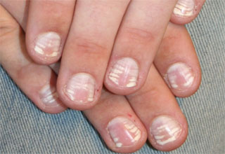 Белые пятна на ногтях причины диагностика лечение