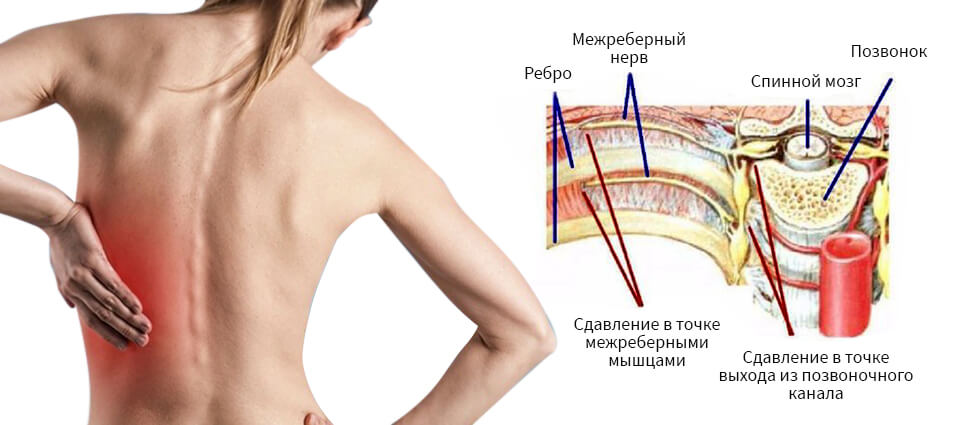 Методы лечения невралгии: