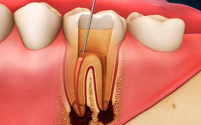 Почему болит зуб после удаления нерва и пломбирования каналов
