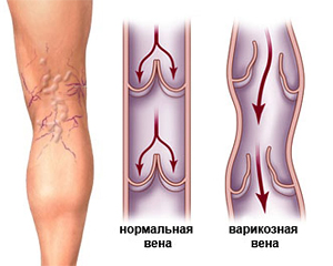 Варикоз – это расширение вен на нижних конечностях, что приводит к нарушению их функционирования и появлению характерных симптомов. Варикозное заболевание может быть вызвано как внутренними факторами (наследственностью, предрасположенностью к варикозу), так и внешними (излишне высокие нагрузки на ноги, длительное стояние или сидение). 
