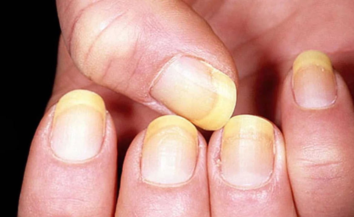 Белые пятна на ногтях у детей