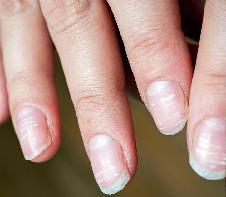 Белые пятна на ногтях лечение