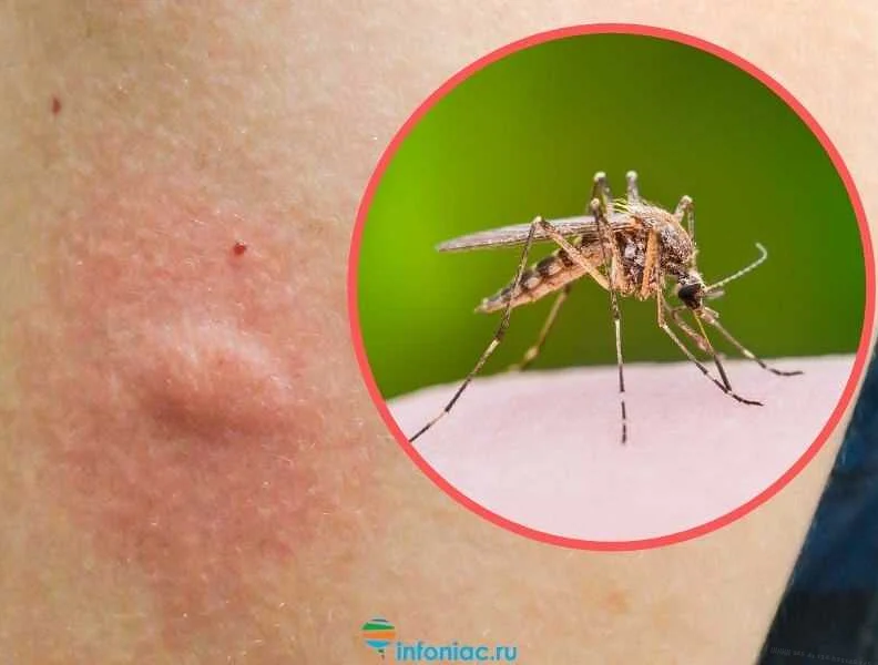 Комары являются одними из самых раздражающих насекомых. Они могут нанести нам немало проблем, в том числе и вредных болезней. Одной из таких болезней, которую можно получить от комаров, является малярия. Для того чтобы избежать укусов комаров и малярийного риска, существует достаточно препаратов и средств защиты.