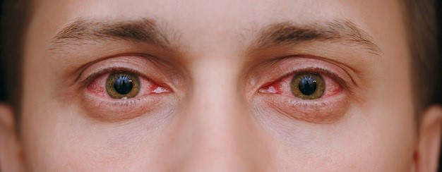 Лечение покраснений и зуда в уголках глаз