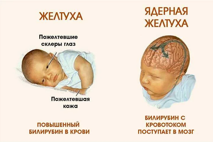 Повышенный билирубин у новорожденных причины