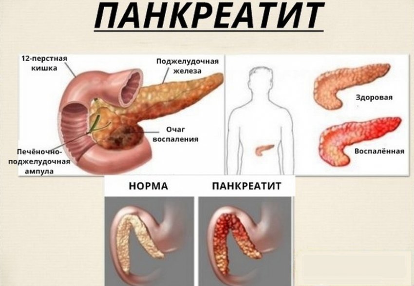 Поджелудочная железа где находится как болит и чем лечить