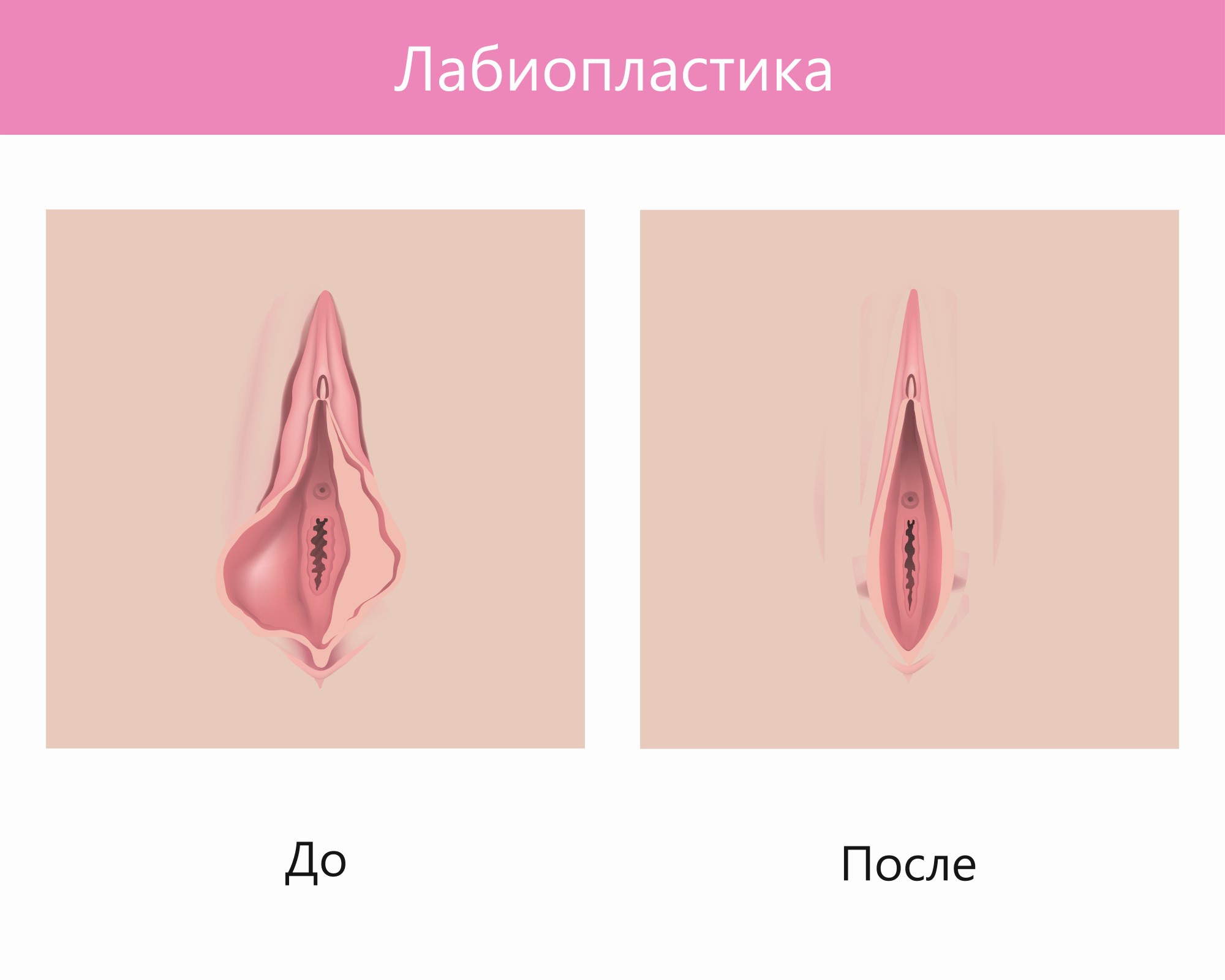 Виды женской интимной пластики