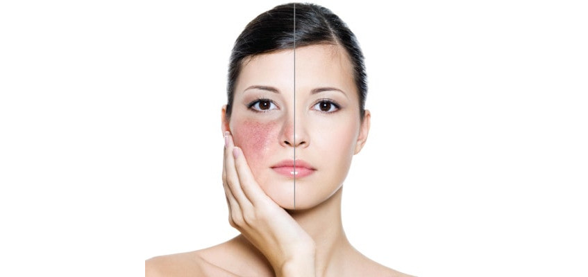 Причины покраснения кожи лица