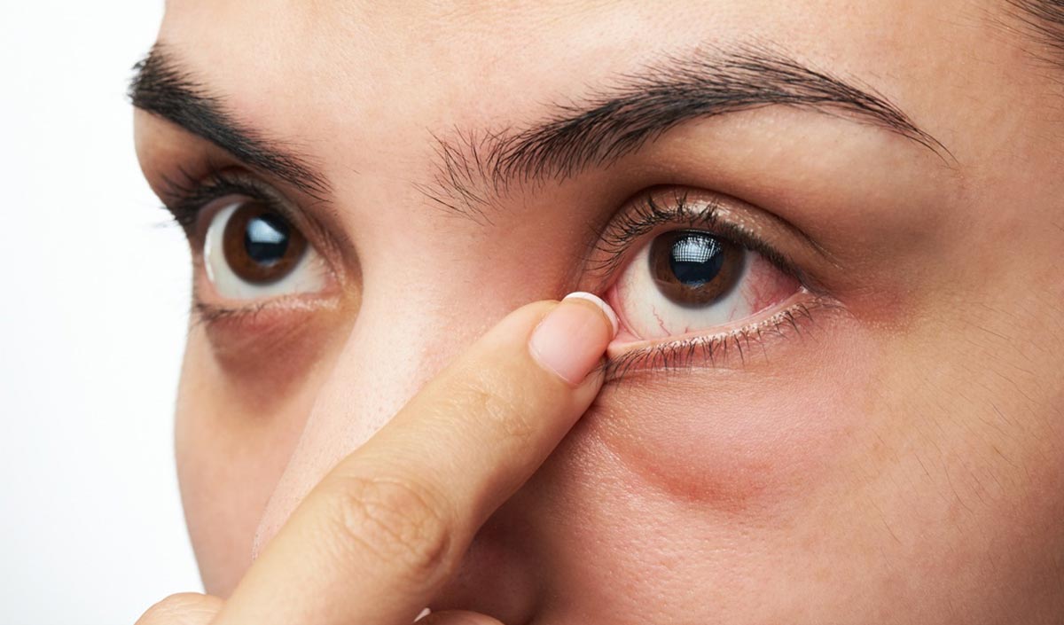 Покраснение и зуд в углу глаза – первый признак развития инфекции