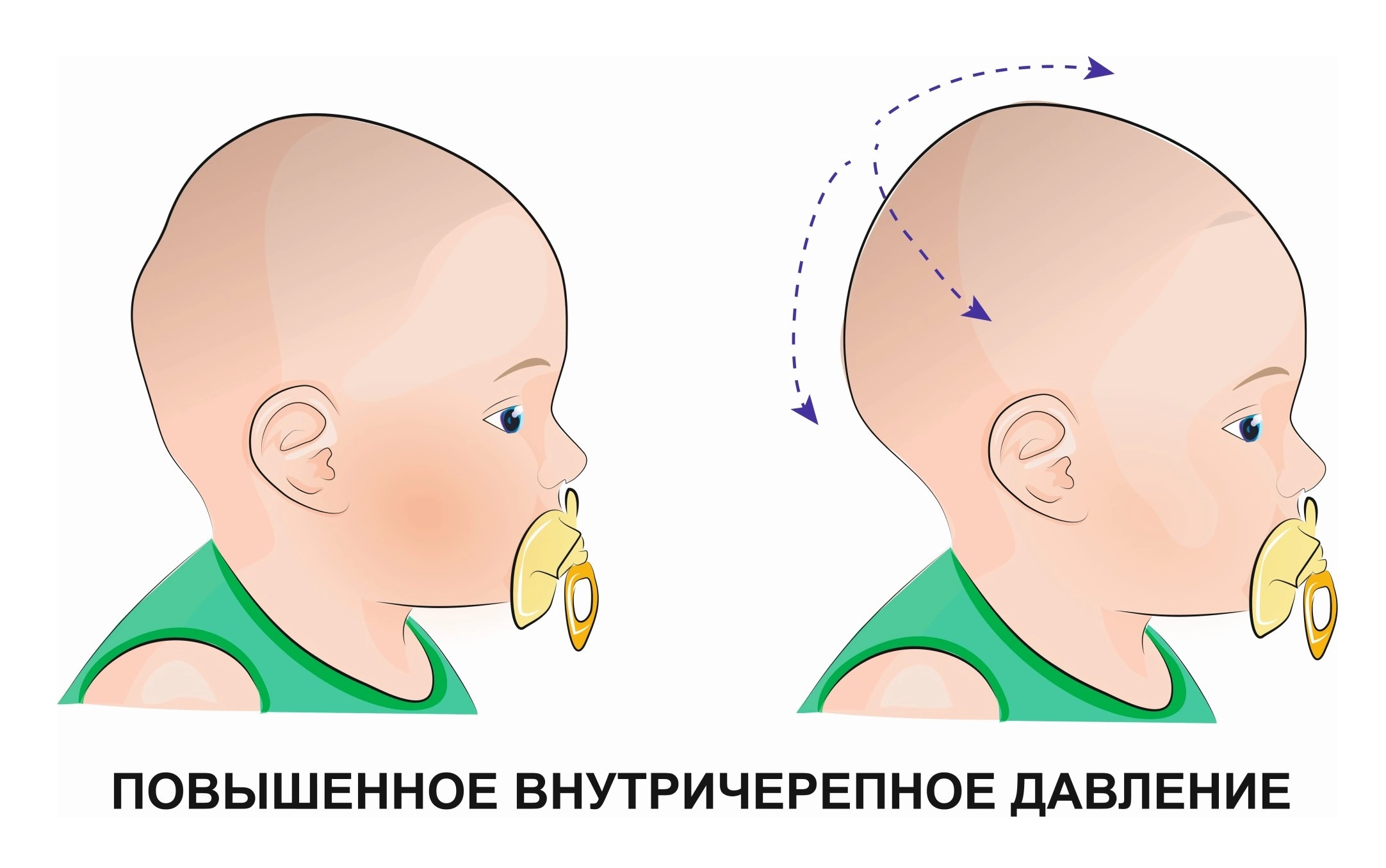 Правильный затылок. Норма формы черепа у младенцев. Форма головы младенца норма. Правильная форма головы у младенца. Форма головы у месячного ребенка.