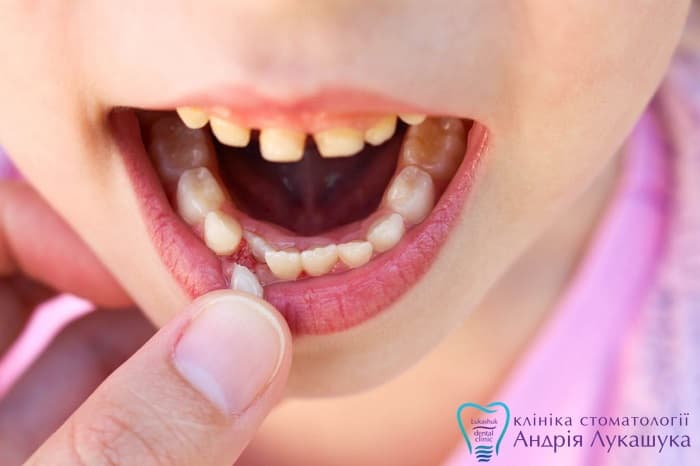 2. Появление дефектов связанных с молочными зубами