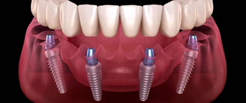 С чего начинается имплантация зубов