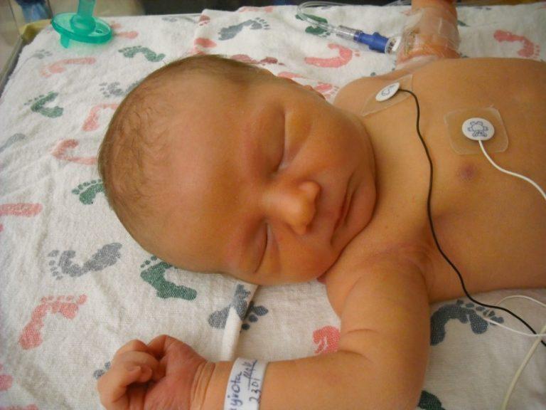 Нормы билирубина у новорожденных