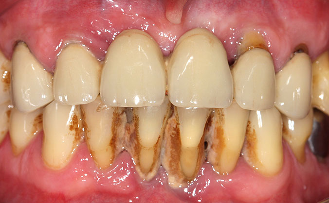 Причины образования зубного камня